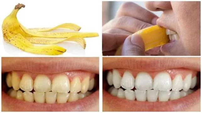 31695 teeth whitening methods