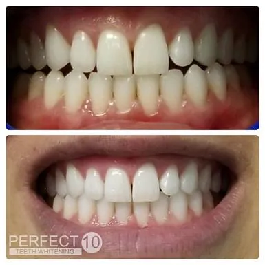 31700 youthful smile