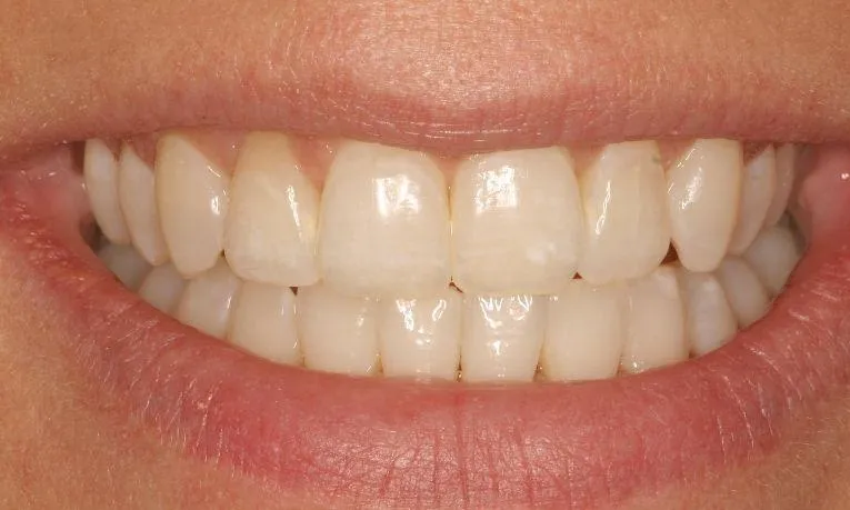 /img/31702-invisalign-smile.webp