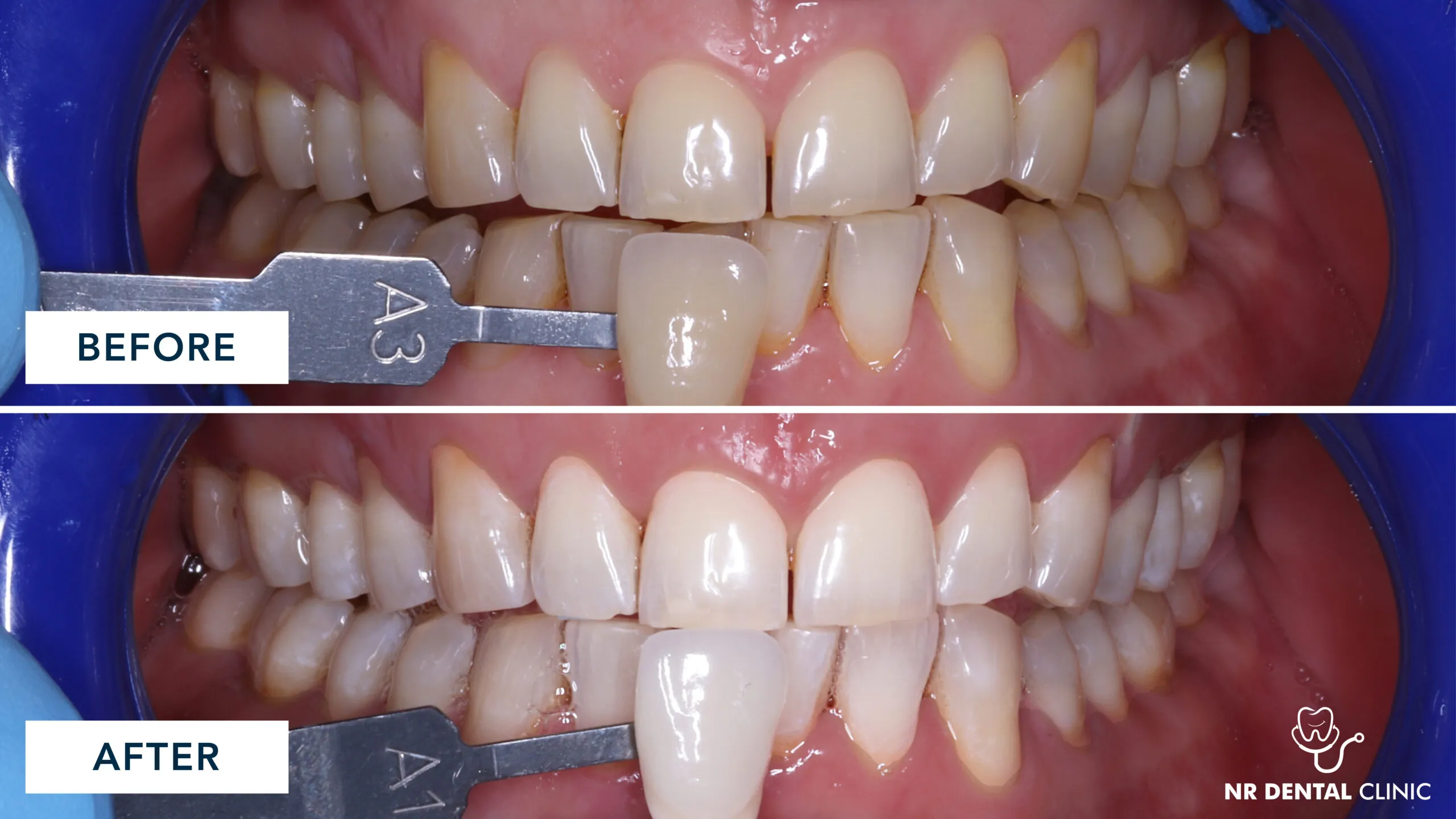 31702 invisalign trays