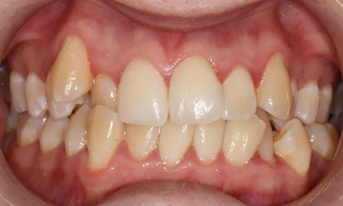 31702 teeth whitening diet