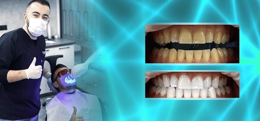 31704 teeth whitening before after