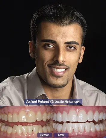 31704 types of teeth whitening