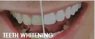 31710 teeth whitening cost