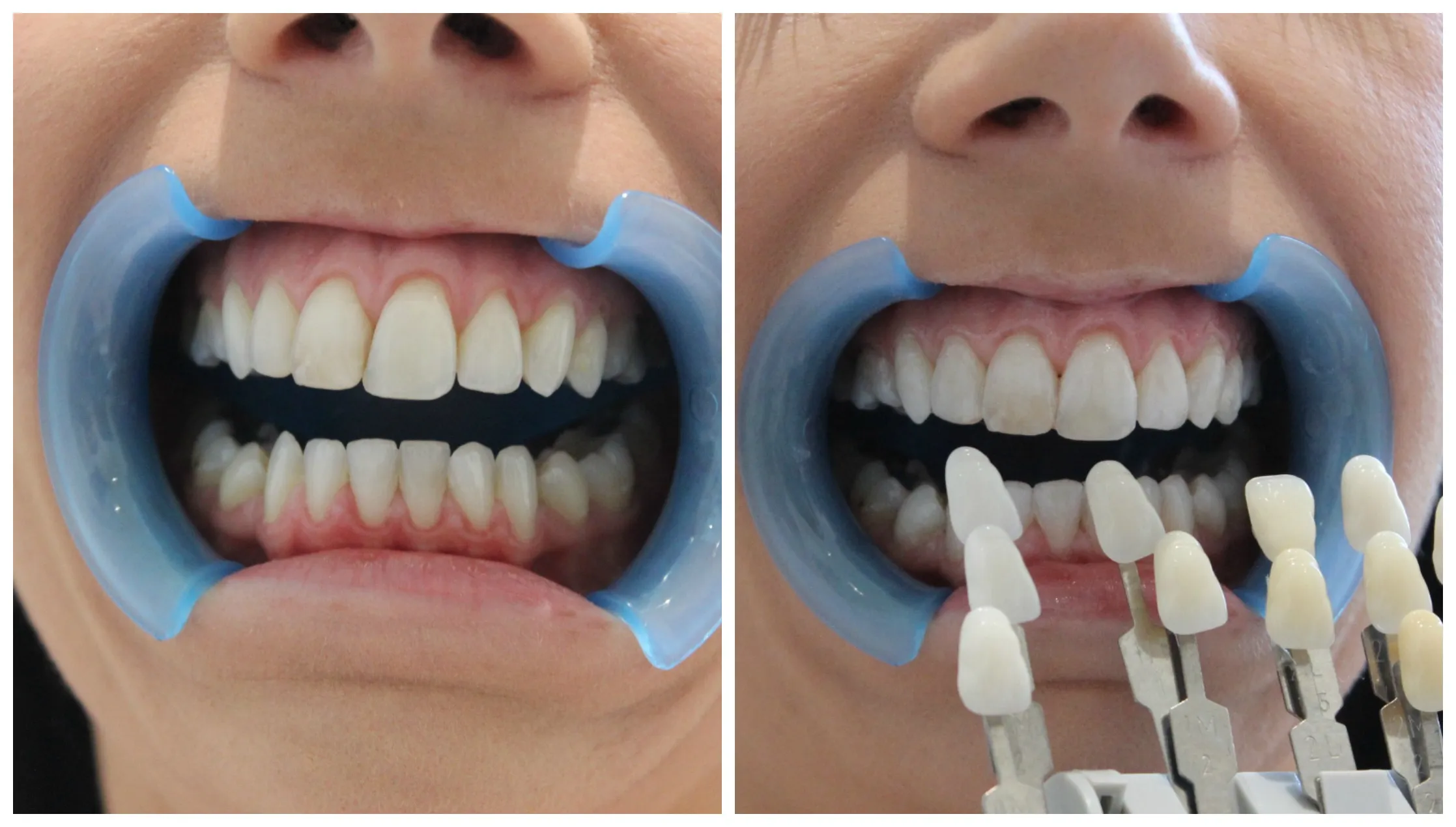 /img/31721-teeth-whitening-near-me-image7.webp