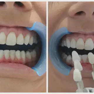 /img/31721-teeth-whitening-near-me-image7.webp
