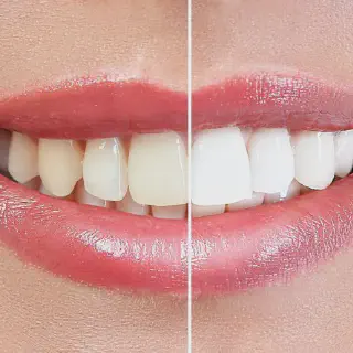 /img/31722-teeth-whitening-nachsorge.webp