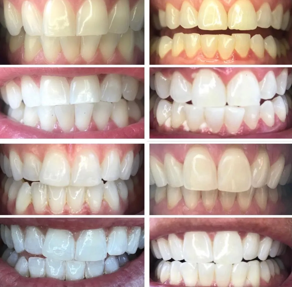 31723 teeth whitening baltimore md 5