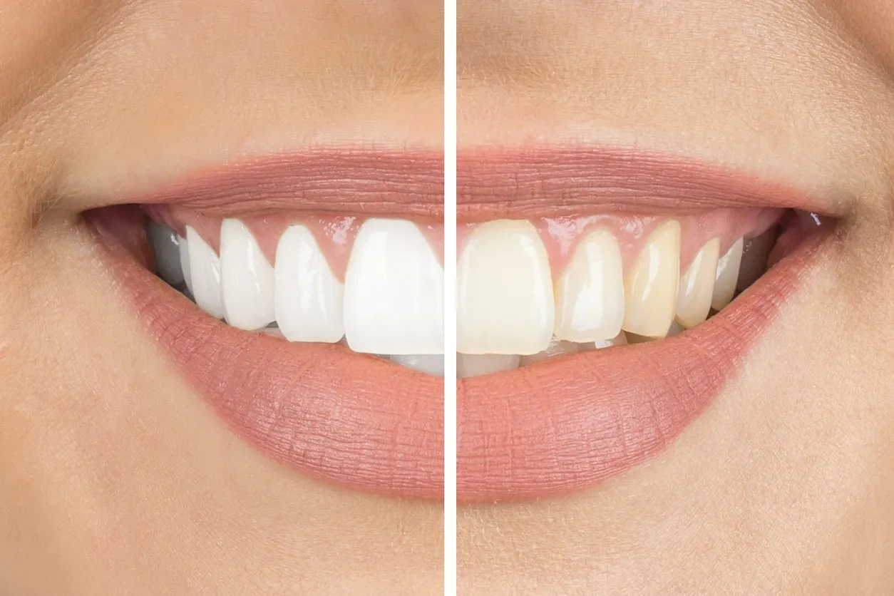 31725 at home teeth whitening