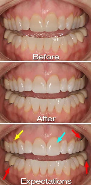 31734 crest 3d white strips