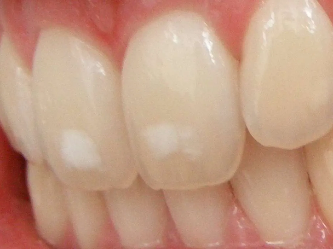 31735 teeth whitening hillcrest healthy smile