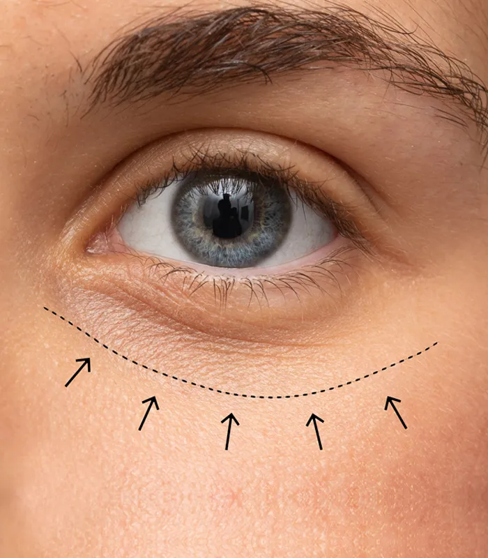 31736 eye whitening surgery uk procedure