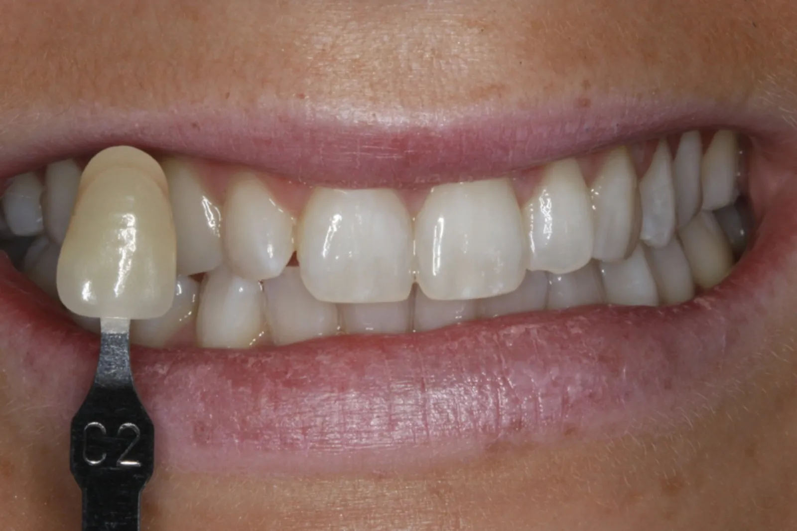 31739 in office teeth whitening