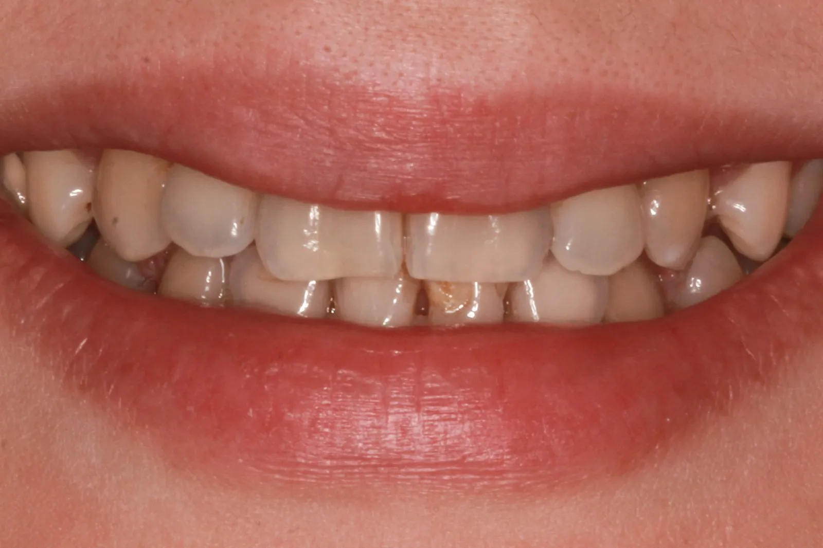 31739 professional teeth whitening