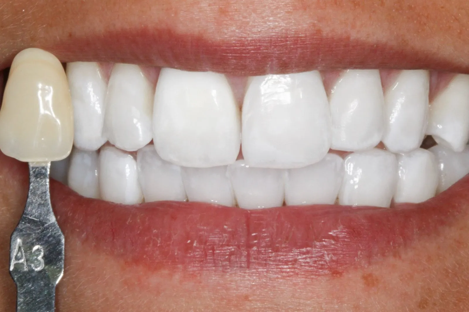 31739 take home teeth whitening