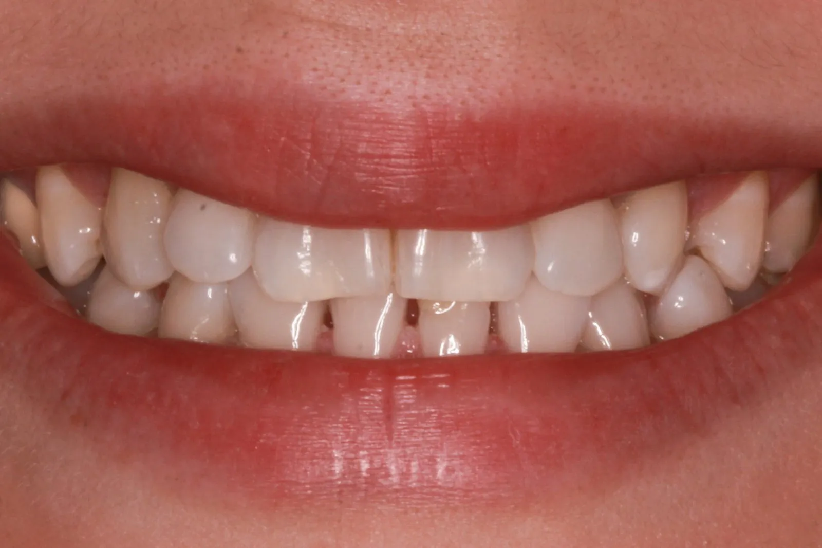 31739 teeth whitening maintenance