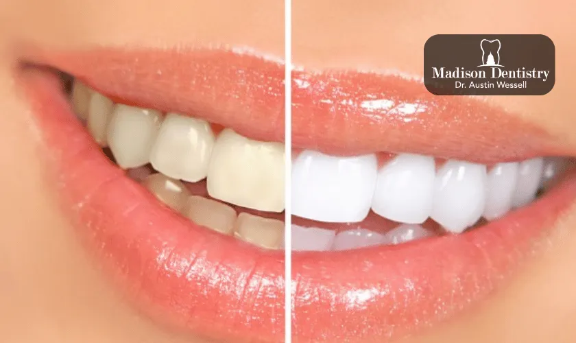 31748 professional teeth whitening procedure