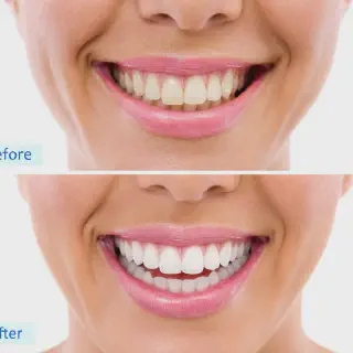 /img/31748-teeth-whitening-cost.webp