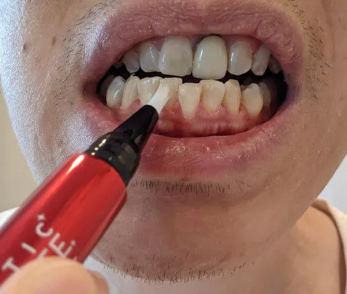 31751 professional teeth whitening