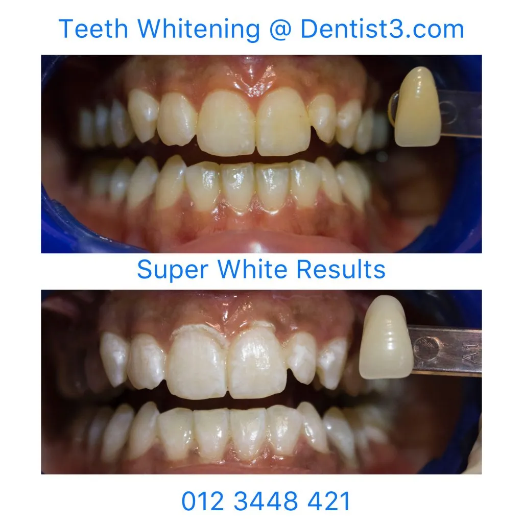 31753 dentist whitening 1