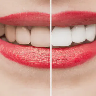 /img/31755-avoiding-teeth-stains.webp
