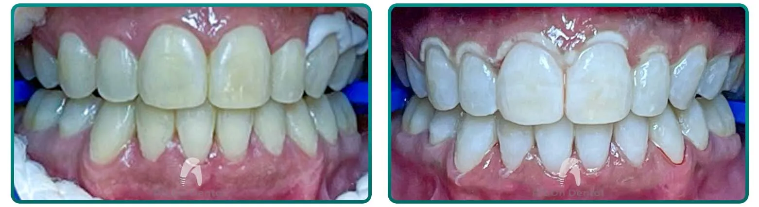 31756 composite fillings whitening