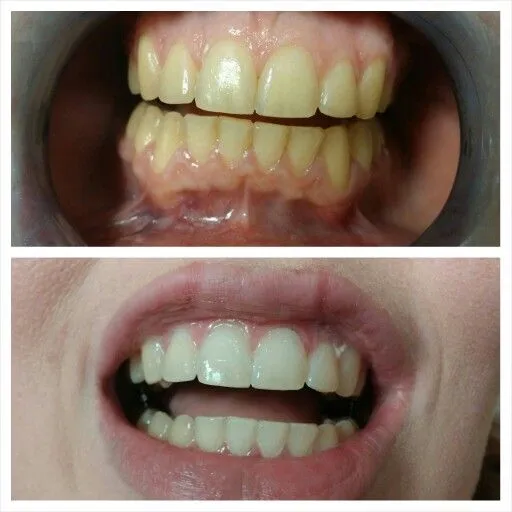 31756 tooth discoloration after root canal