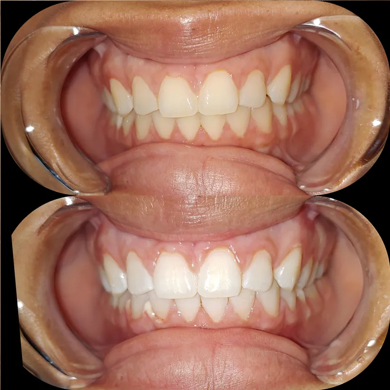 31759 teeth whitening new orleans 4