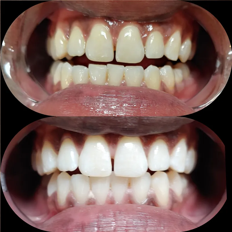 31759 teeth whitening new orleans 5