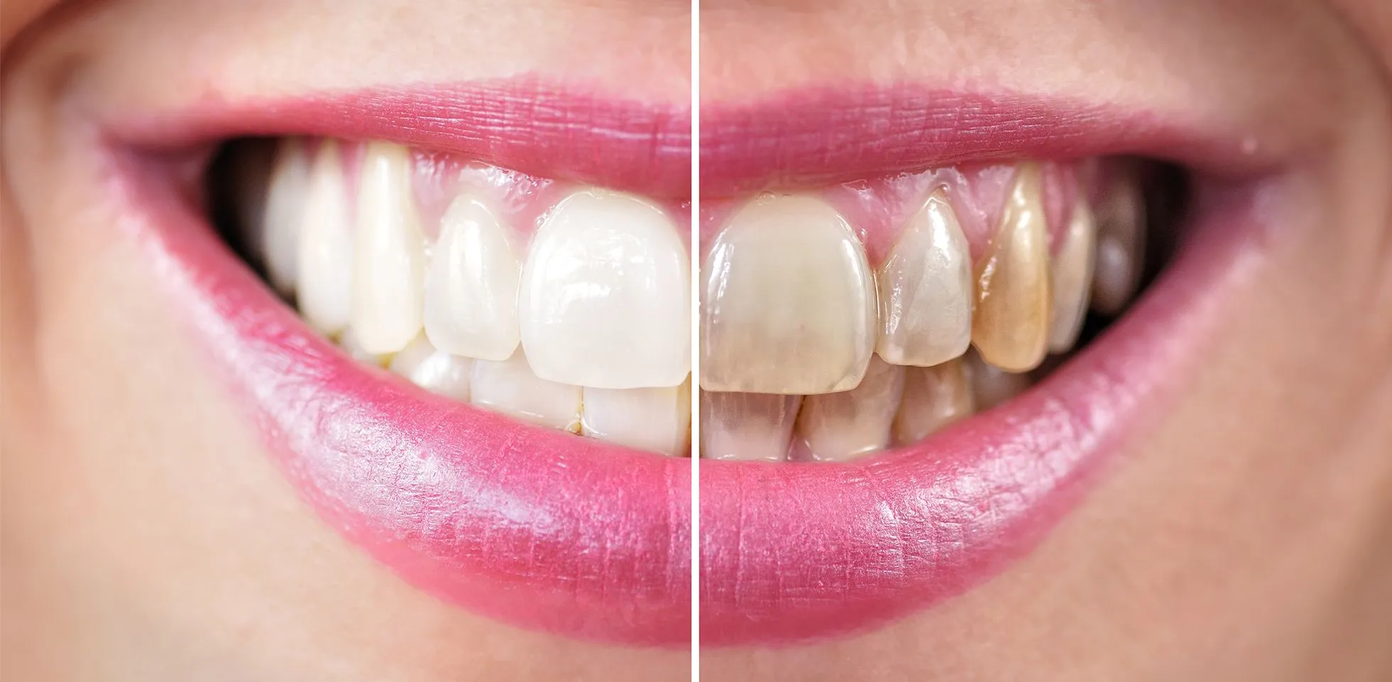 31760 teeth whitening methods