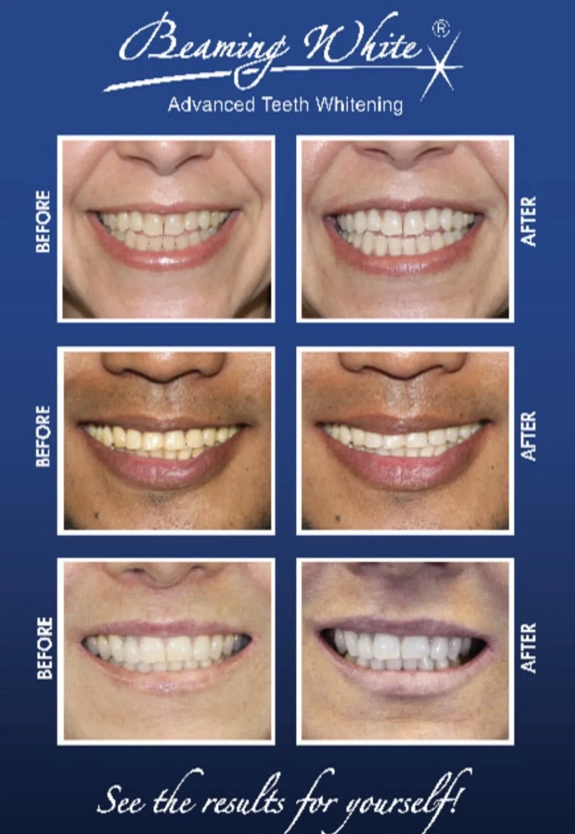 31766 finding dentist teeth whitening olympia