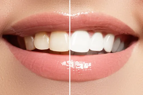 31766 olympia teeth whitening before after