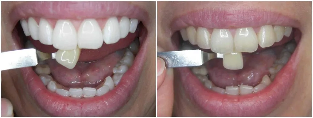 31772 teeth whitening columbia md image1