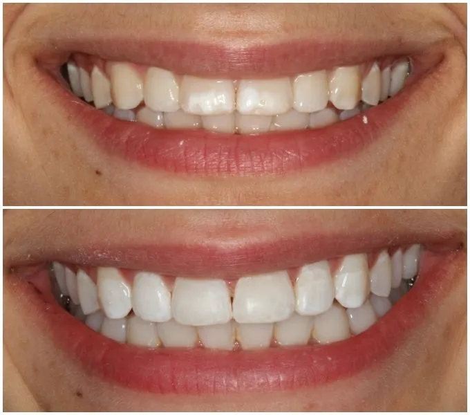 31772 teeth whitening columbia md image5