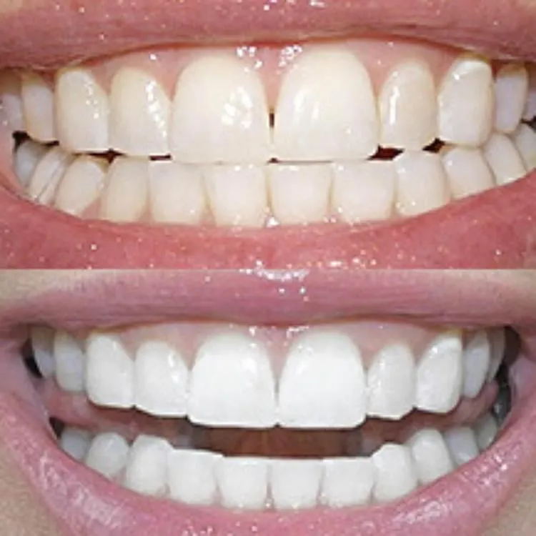 31772 teeth whitening columbia md image6