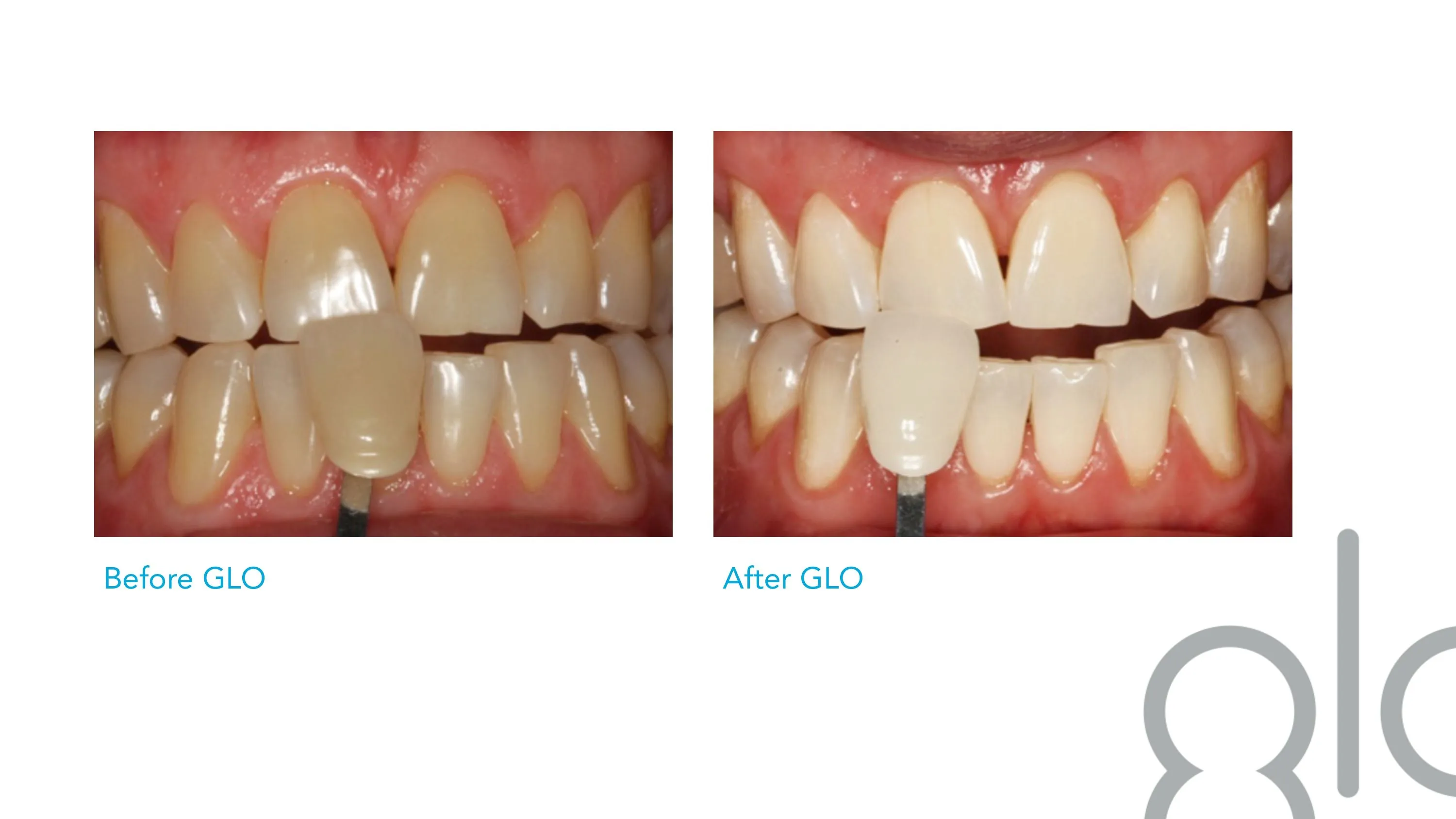 31775 teeth staining
