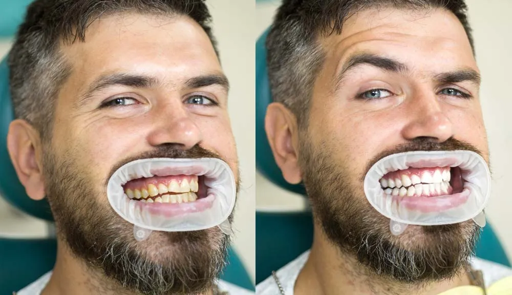 31777 candidate teeth whitening