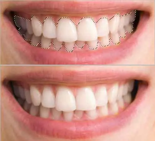 31778 teeth whitening before after
