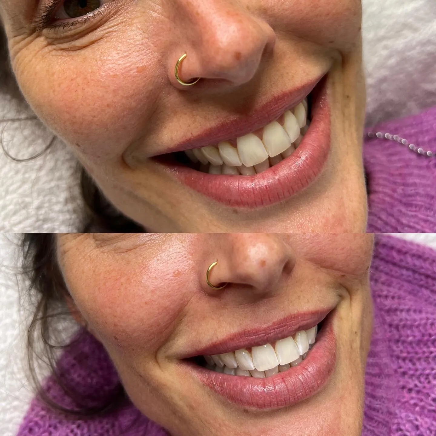 31787 nuova white teeth whitening application