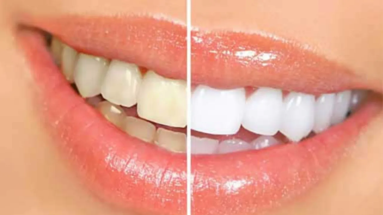 /img/31799-teeth-whitening-allergic-reaction.webp