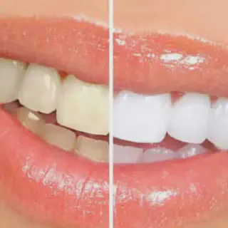 /img/31799-teeth-whitening-allergic-reaction.webp