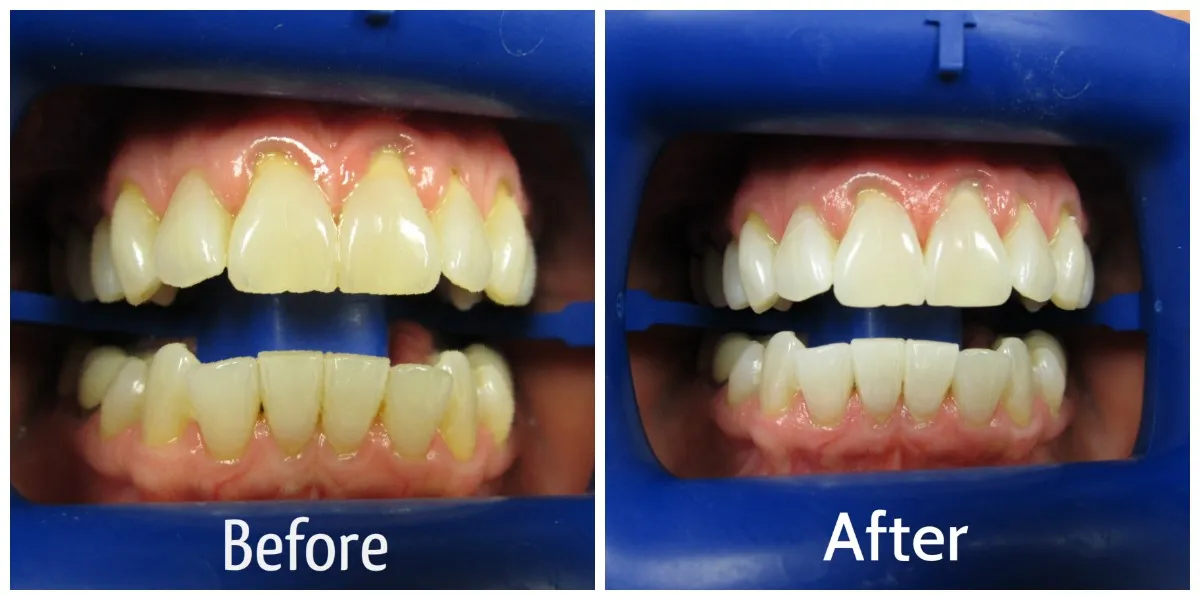 31801 zoom whitening process