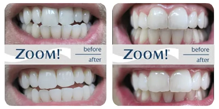 31804 zoom whitening alternatives