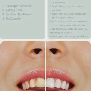 /img/31807-hydrogen-peroxide-teeth.webp