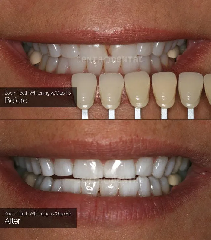 31808 zoom whitening before after