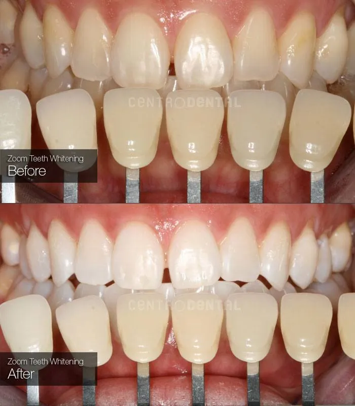 31808 zoom whitening process