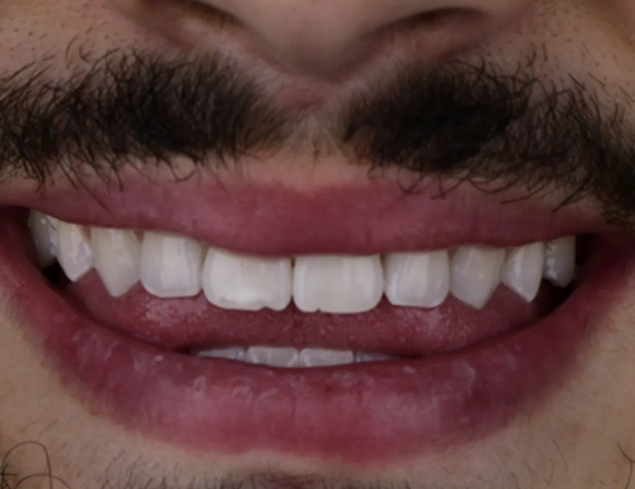 31809 laser teeth whitening equipment