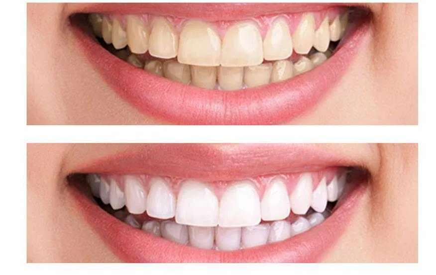 31810 teeth discoloration